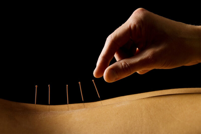 Acupuncture for Back Pain: How This Ancient Practice Can Offer Modern Relief